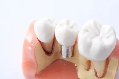 Dental Crown & Bridge